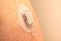 CGM - Continuous glucose monitoring: sensor installation on the upper arm. Sensor pod. transmitter and transmitter latch