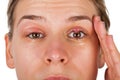 Chalazion - Eyelid infection Royalty Free Stock Photo