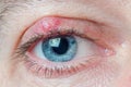 Chalazion on the eyelid of a man close-up