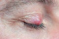 Chalazion on the eyelid of a man close-up