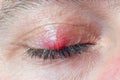 Chalazion on the eyelid of a man close-up Royalty Free Stock Photo