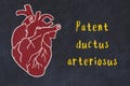 Chalk sketch of human heart on black desc and inscription Patent ductus arteriosus
