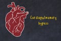 Chalk sketch of human heart on black desc and inscription Cardiopulmonary bypass