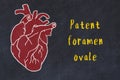 Chalk sketch of human heart on black desc and inscription Patent foramen ovale Royalty Free Stock Photo