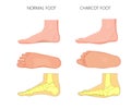 Charcot foot