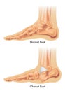 Charcot foot