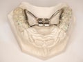 Check hyrax braces on dental gypsum model