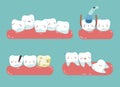 Check up decayed tooth , Wisdom tooth of dental set