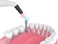 Checking dental implant stability by osseointegration monitoring device