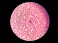 Chediak-Higashi Syndrome - Blood Test Royalty Free Stock Photo