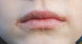 Cheilitis on the lips. Inflamed lips.Skin diseases and dermatology