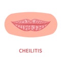 Cheilitis dry lip inflammation outbreak medical icon