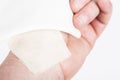 chemical burn on the wrist skin with hydroxide sodium acid. Household accident, because of gloves to sharp Royalty Free Stock Photo