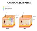 Chemical peels Royalty Free Stock Photo
