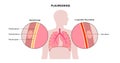 Pleurodesis medical procedure