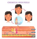 Chemical skin peels vector illustration diagram Royalty Free Stock Photo