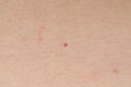 Cherry Angioma or Campbell de Morgan spots