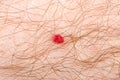 Cherry angioma on human skin