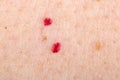 Cherry angioma on human skin