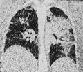 Chest CT Scan of Coronavirus COVID-19 pneumonia