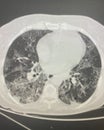 Chest CT Scan of novel Coronavirus COVID-19