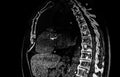 Chest CT Scan showing metastatic tumoral lesions on the vertebra