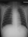 Chest film antero-posterior (AP) view of a 15 years old man with lymphoma, demonstrated both hilar lymph nodes enlargement.