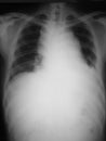 Chest film antero-posterior (AP) view of a 21 years old man, demonstrated mediastinal mass and blunting of left costophrenic angle