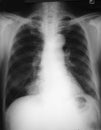Chest film antero-posterior (AP) view of a 69 years old man, demonstrated right lower lung (RLL) mass. Final diagnosis is
