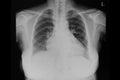 A chest film of a patient with cardiomegaly