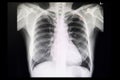 Chest film of a patient with lung nodule Royalty Free Stock Photo