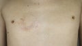 Chest of a man with a scar on the right side and a lot of moles on the skin