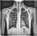 Chest Medical Xray, Lungs and Heart View Royalty Free Stock Photo