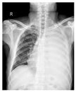 Chest Opacified Lt thorax.