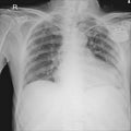 CHEST PA UPRIGHT: Evidence of single-chamber pacemaker with its tip at RV is recently Royalty Free Stock Photo