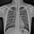 Chest radiography of a hospital patient