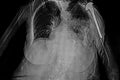 Chest RX patient with left humerus prosthesis and left side diaphragm elevation