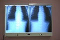 Chest and thorax x-ray on a viewing light box
