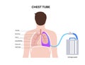 Chest tube catheter Royalty Free Stock Photo