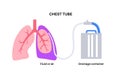 Chest tube catheter