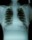 Chest x-ray