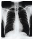 Chest x-ray