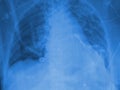 Chest X-ray. Blue toning. Royalty Free Stock Photo