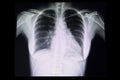 a chest x ray film of a patient with cardiomegaly