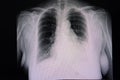 cardiomegaly and left pleural effusion