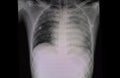 Chest x-ray film of a patient with cardiomegaly and pulmonary edema