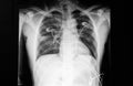 Chest X ray film of a patient with dyspnea Royalty Free Stock Photo