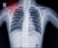 Chest x-ray fracture right clavicle