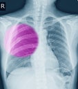 Chest x-ray Fracture right posterior 6th rib and possible fracture lateral aspect of left 9th rib