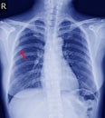 Chest x-ray Fracture right posterior 6th rib and possible fracture lateral aspect of left 9th rib